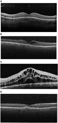 Deep learning-based classification of eye diseases using Convolutional Neural Network for OCT images